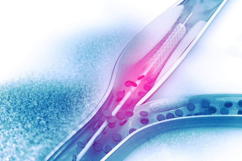 Periphere arterielle Verschlusskrankheit